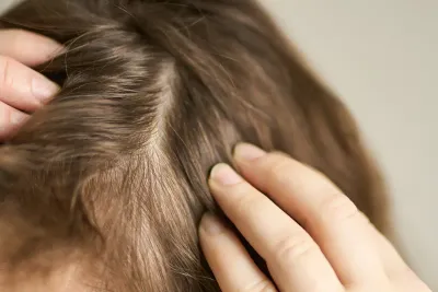 Calvície Feminina: Como Reconhecer a Alopecia Androgenética