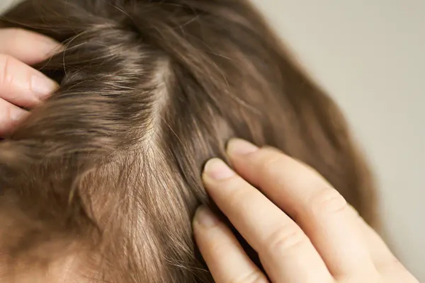 Calvície Feminina: Como Reconhecer a Alopecia Androgenética