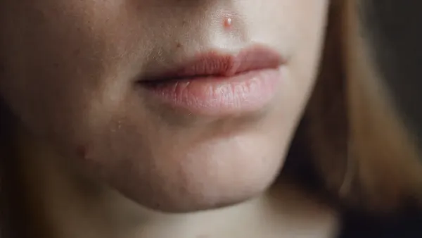 Cicatrizes de Acne: Estratégias Regenerativas para Pele Premium