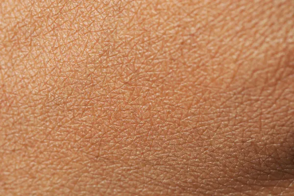 Peeling Químico